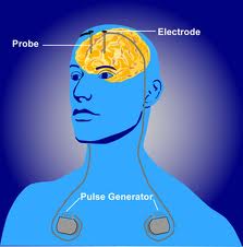 Deep Brain Simulation Surgery